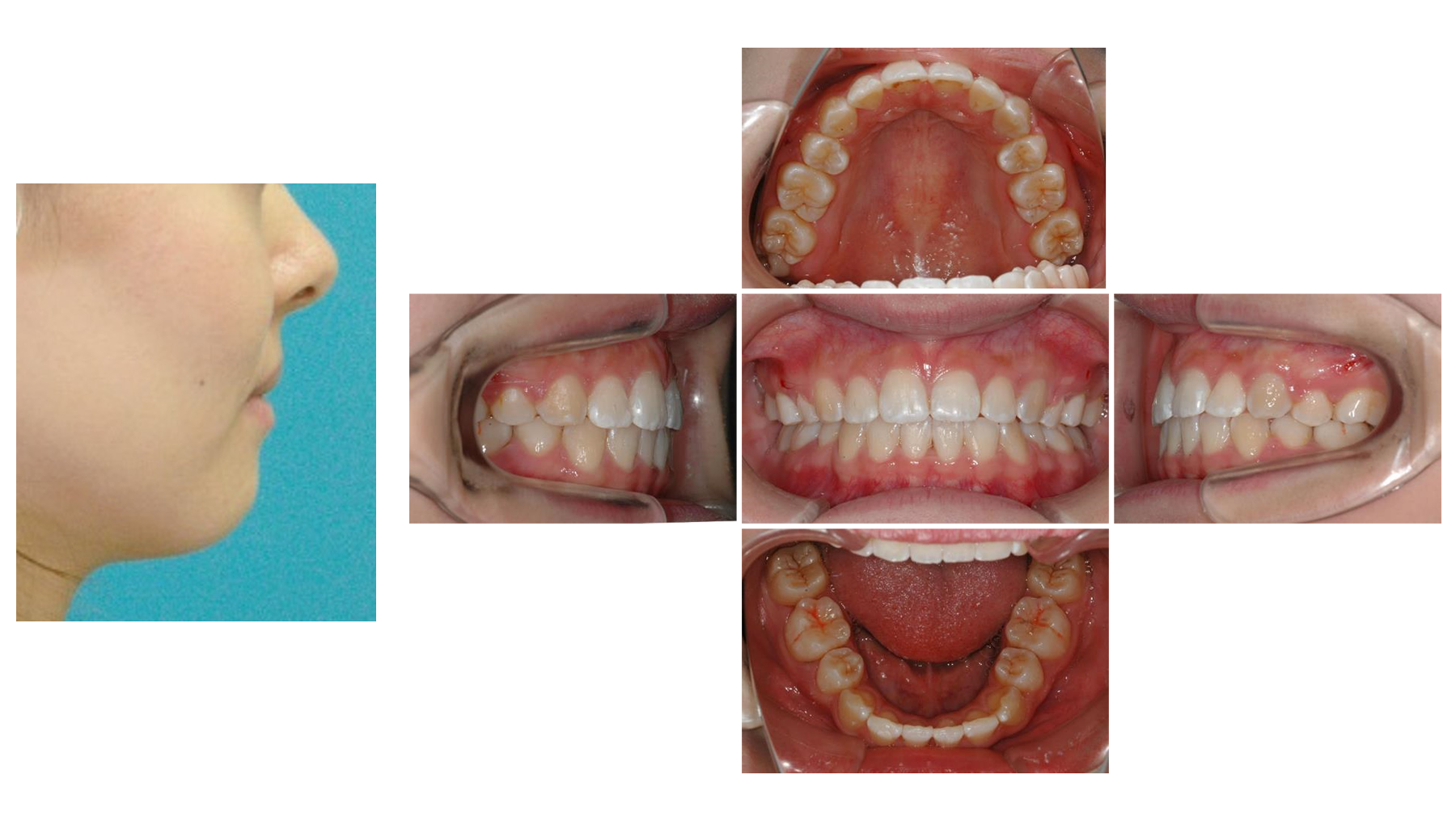 千葉市中央区千葉寺・おおもり歯科クリニック・Case3　上下顎前突症例